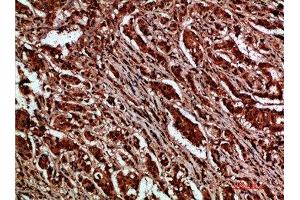 Immunohistochemical analysis of paraffin-embedded human-breast-cancer, antibody was diluted at 1:200 (CTNND1 anticorps)