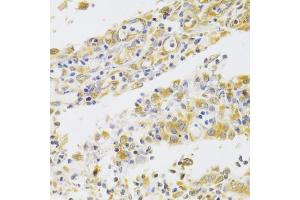 Immunohistochemistry of paraffin-embedded human gastric cancer using PA2G4 Antibody (ABIN5973112) at dilution of 1/100 (40x lens). (PA2G4 anticorps)