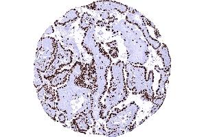 Papillary thyroid cancer with strong nuclear TRIM28 immunostaining of tumor cells (Recombinant KAP1 anticorps  (Center))