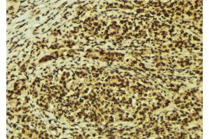 ABIN6274176 at 1/100 staining Human breast cancer tissue by IHC-P. (TCF3 anticorps  (Internal Region))