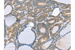 The image on the left is immunohistochemistry of paraffin-embedded Human thyroid cancer tissue using ABIN7192586(SNX29 Antibody) at dilution 1/20, on the right is treated with synthetic peptide. (SNX29 anticorps)