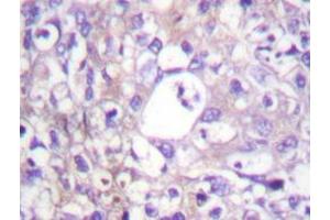 Immunohistochemistry analyzes of SH-PTP2 antibody in paraffin-embedded human breast carcinoma tissue. (PTPN11 anticorps)