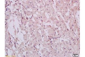Formalin-fixed and paraffin embedded human hepatitides tissue labeled with Anti HBXIP Polyclonal Antibody,Unconjugated (ABIN873319) at 1:200 followed by conjugation to the secondary antibody and DAB staining. (HBXIP anticorps  (AA 41-91))
