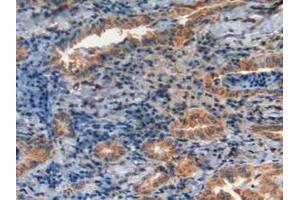 IHC-P analysis of Human Thyroid Cancer Tissue, with DAB staining. (GLA anticorps  (AA 1-80))