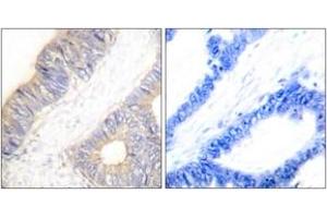 Immunohistochemistry analysis of paraffin-embedded human colon carcinoma tissue, using Stefin A Antibody. (CSTA anticorps  (AA 49-98))