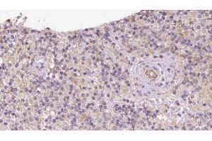 ABIN6273095 at 1/100 staining Human lymph cancer tissue by IHC-P. (CCDC22 anticorps  (C-Term))