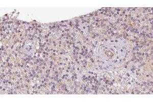 ABIN6273095 at 1/100 staining Human lymph cancer tissue by IHC-P.