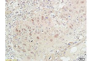 Formalin-fixed and paraffin embedded human oral squamous cell carcinoma labeled with Anti- PCNA-Proliferation Marker Polyclonal Antibody, Unconjugated (ABIN676583) at 1:100 followed by conjugation to the secondary antibody and DAB staining (PCNA anticorps  (AA 151-261))