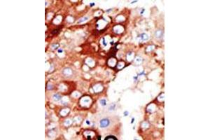 Formalin-fixed and paraffin-embedded human cancer tissue reacted with the primary antibody, which was peroxidase-conjugated to the secondary antibody, followed by DAB staining. (ACSL4 anticorps  (AA 236-267))