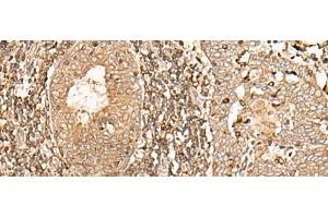 Immunohistochemistry of paraffin-embedded Human esophagus cancer tissue using GALR2 Polyclonal Antibody at dilution of 1:40(x200) (GALR2 anticorps)