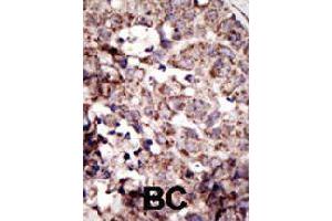 Formalin-fixed and paraffin-embedded human cancer tissue reacted with AGER polyclonal antibody  , which was peroxidase-conjugated to the secondary antibody, followed by AEC staining . (RAGE anticorps  (N-Term))