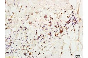 Formalin-fixed and paraffin embedded human breast carcinoma labeled with Anti-MCP-2 Polyclonal Antibody, Unconjugated  at 1:200 followed by conjugation to the secondary antibody and DAB staining (CCL8 anticorps  (AA 24-99))