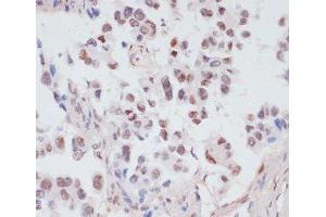 Immunohistochemistry of paraffin-embedded Human lung cancer using Phospho-PEA15(S104) Polyclonal Antibody at dilution of 1:100 (40x lens).