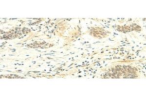 Immunohistochemistry of paraffin-embedded Human esophagus cancer tissue using ATMIN Polyclonal Antibody at dilution of 1:50(x200) (ATM Interactor anticorps)