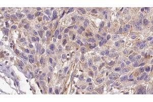 ABIN6272953 at 1/100 staining Human Melanoma tissue by IHC-P. (AGGF1 anticorps  (Internal Region))