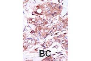 Formalin-fixed and paraffin-embedded human cancer tissue reacted with the primary antibody, which was peroxidase-conjugated to the secondary antibody, followed by DAB staining. (ERBB4 anticorps  (C-Term))
