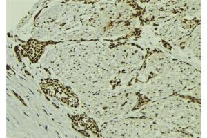 ABIN6273133 at 1/100 staining Human breast cancer tissue by IHC-P. (MGH1/2 anticorps)
