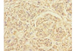 Immunohistochemistry of paraffin-embedded human pancreatic cancer using ABIN7167664 at dilution of 1:100 (Relaxin 3 Receptor 1 anticorps  (AA 1-80))