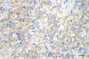 Immunohistochemistry was performed on paraffin-embedded human glioblastoma using huntingtin antibody (ABIN7799005), 1:200). (Recombinant Huntingtin anticorps)