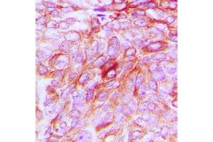 Immunohistochemical analysis of Phospholipase D4 staining in human breast cancer formalin fixed paraffin embedded tissue section. (Phospholipase D4 anticorps  (C-Term))