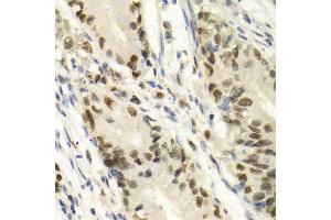 Immunohistochemistry of paraffin-embedded Human gastric cancer using KPNA4 antibody at dilution of 1:100 (x400 lens). (KPNA4 anticorps  (AA 1-240))