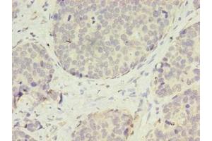 Immunohistochemistry of paraffin-embedded human gastric cancer using ABIN7175400 at dilution of 1:100 (Vasohibin 2 anticorps  (AA 1-156))