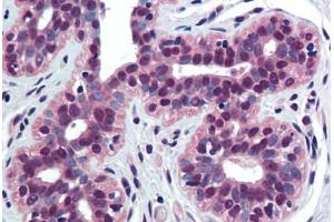 Human Breast (formalin-fixed, paraffin-embedded) stained with TNFRSF10B antibody ABIN290834 at 10 ug/ml followed by biotinylated goat anti-rabbit IgG secondary antibody ABIN481713, alkaline phosphatase-streptavidin and chromogen. (TNFRSF10B anticorps  (AA 388-407))