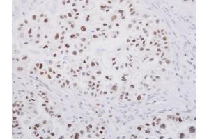 IHC-P Image SP1 antibody detects SP1 protein at nucleus on human ovarian carcinoma by immunohistochemical analysis.