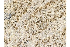 YTHDC1 Mouse Monoclonal Antibody at 1/100 staining human lung cancer by IHC-P. (YTHDC1 anticorps)