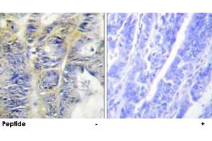 Immunohistochemistry analysis of paraffin-embedded human colon carcinoma tissue using COL4A5 polyclonal antibody . (COL4a5 anticorps)