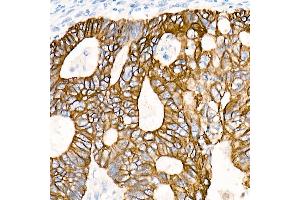 Immunohistochemistry of paraffin-embedded Human colon carcinoma using Cytokeratin 19 (KRT19) antibody (ABIN7268099) at dilution of 1:100 (40x lens). (Cytokeratin 19 anticorps)