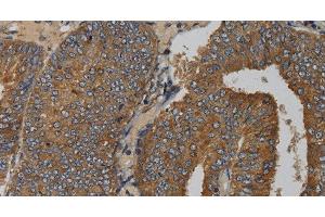 Immunohistochemistry of paraffin-embedded Human colon cancer tissue using MAS1 Polyclonal Antibody at dilution 1:50 (MAS1 anticorps)