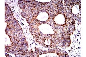 Immunohistochemical analysis of paraffin-embedded rectum cancer tissues using SOD2 mouse mAb with DAB staining. (SOD2 anticorps  (AA 1-222))
