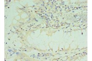 Immunohistochemistry of paraffin-embedded human colon cancer using ABIN7172205 at dilution of 1:100