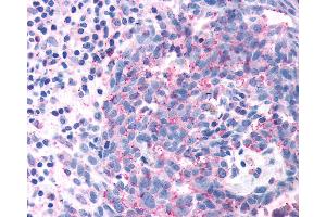 Anti-OR2A4 antibody IHC of human Skin, Melanoma.