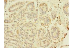Immunohistochemistry of paraffin-embedded human breast cancer using ABIN7171326 at dilution of 1:100