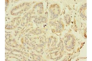 Immunohistochemistry of paraffin-embedded human breast cancer using ABIN7171326 at dilution of 1:100 (TAGAP anticorps  (AA 97-260))