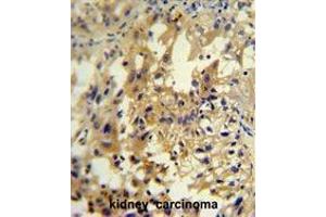 UPP2 antibody (C-term) immunohistochemistry analysis in formalin fixed and paraffin embedded human kidney carcinoma followed by peroxidase conjugation of the secondary antibody and DAB staining. (UPP2 anticorps  (C-Term))
