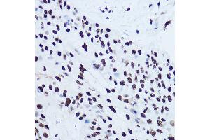 Immunohistochemistry of paraffin-embedded human lung cancer using SSB Rabbit pAb (ABIN3015264, ABIN3015265, ABIN3015266 and ABIN6213909) at dilution of 1:300 (40x lens).