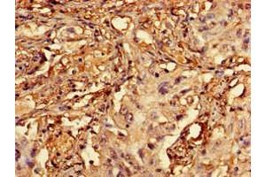 Immunohistochemistry of paraffin-embedded human lung cancer using ABIN7167421 at dilution of 1:100 (RCBTB2 anticorps  (AA 1-200))