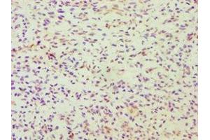 Immunohistochemistry of paraffin-embedded human breast cancer using ABIN7164363 at dilution of 1:100 (DDX5 anticorps  (AA 1-290))