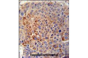 GPLD1 Antibody immunohistochemistry analysis in formalin fixed and paraffin embedded human hepatocarcinoma tissue followed by peroxidase conjugation of the secondary antibody and DAB staining. (GPLD1 anticorps  (C-Term))