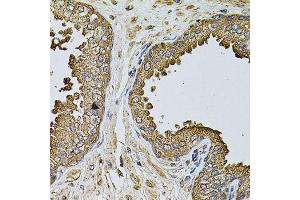 Immunohistochemistry of paraffin-embedded human prostate using MTIF3 antibody (ABIN5974622) at dilution of 1/100 (40x lens). (MTIF3 anticorps)