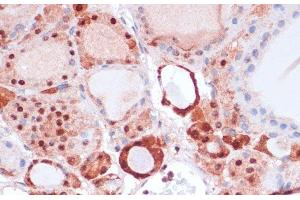 Immunohistochemistry of paraffin-embedded Human thyroid cancer using S100A5 Polyclonal Antibody at dilution of 1:100 (40x lens). (S100A5 anticorps)