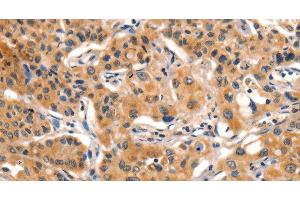 Immunohistochemistry of paraffin-embedded Human lung cancer tissue using AIM2 Polyclonal Antibody at dilution 1:60 (AIM2 anticorps)