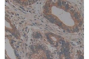 Detection of CX3CL1 in Human Stomach cancer Tissue using Polyclonal Antibody to Chemokine C-X3-C-Motif Ligand 1 (CX3CL1)