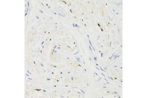 Immunohistochemistry of paraffin-embedded human breast cancer using GEMIN2 Antibody. (SIP1 anticorps)