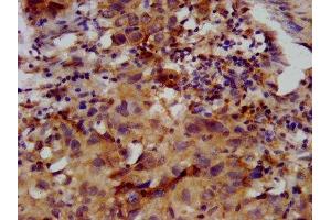 IHC image of ABIN7153231 diluted at 1:400 and staining in paraffin-embedded human ovarian cancer performed on a Leica BondTM system. (FKRP anticorps  (AA 28-140))