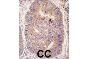 Formalin-fixed and paraffin-embedded human colon carcinoma tissue reacted with hTASP1-C-term (ABIN388126 and ABIN2846334) , which was peroxidase-conjugated to the secondary antibody, followed by DAB staining.
