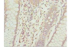 Immunohistochemistry of paraffin-embedded human colon cancer using ABIN7144060 at dilution of 1:100 (ZFAND3 anticorps  (AA 1-227))